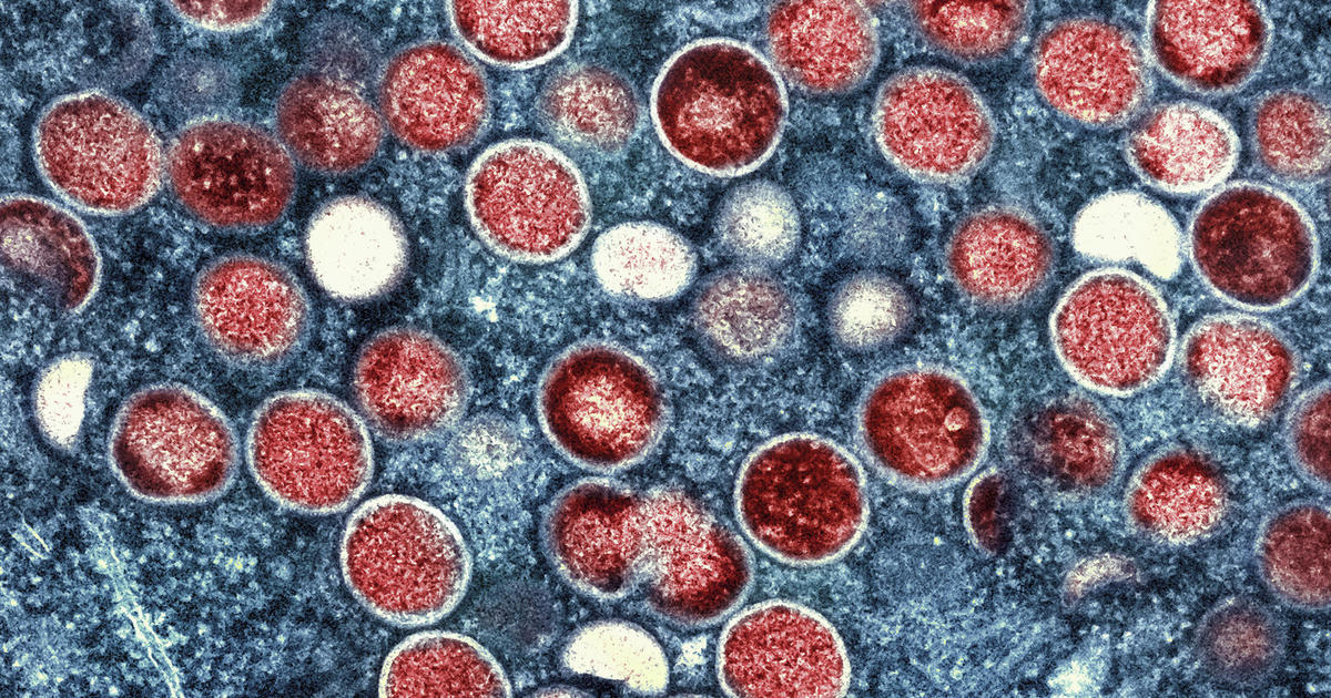 U.S. health officials report 1st case of new form of mpox in a traveler